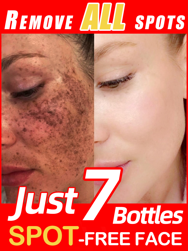Lighten Freckles Melasma, Faci - Luxury Skincare Essence ulasan dan harga